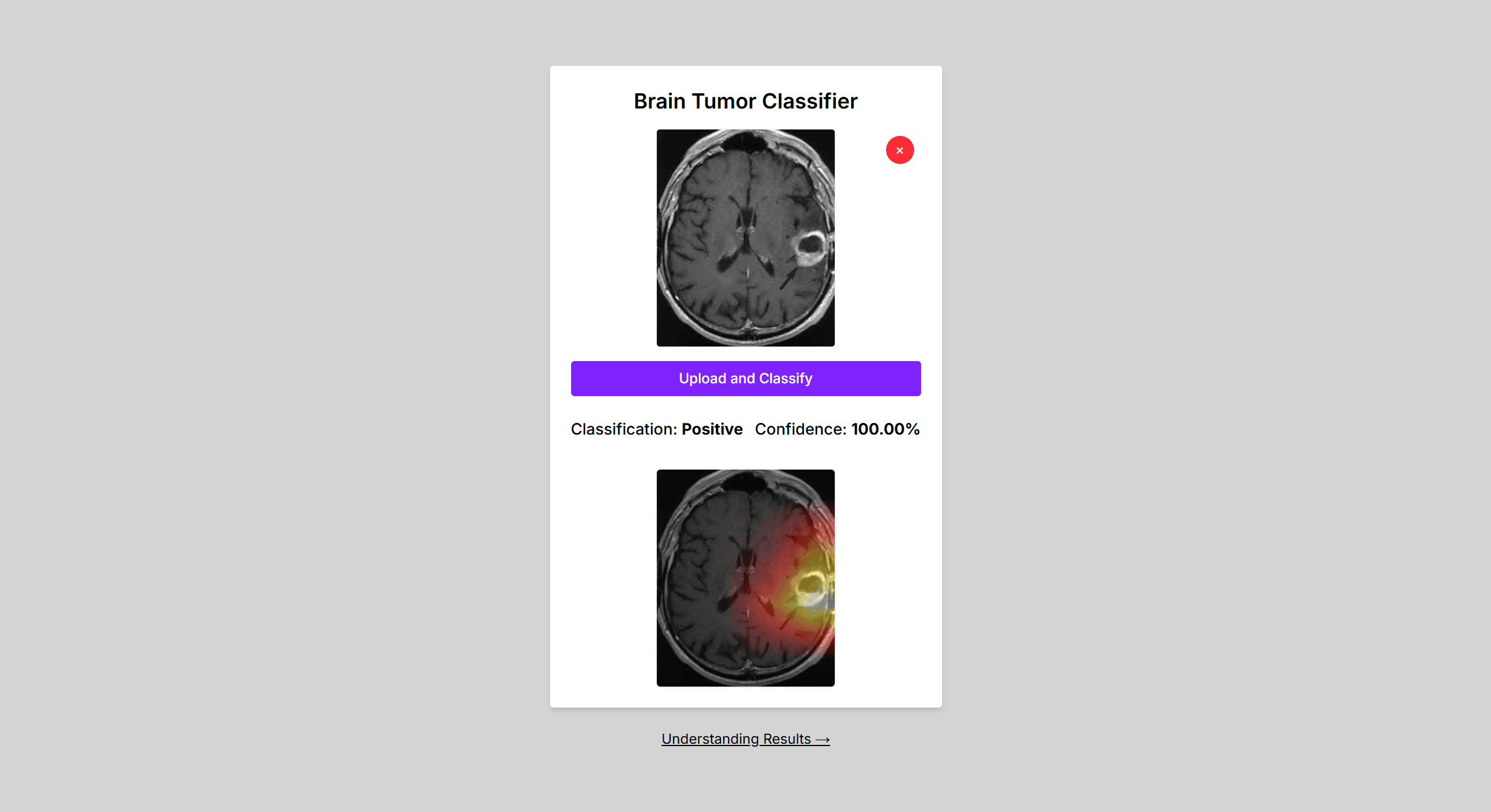 Brain Tumour Identifier